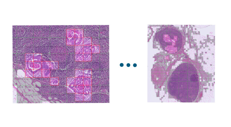 LNMFinder visualization of histological lymph node slides with highlighted suspicious regions for metastasis detection.